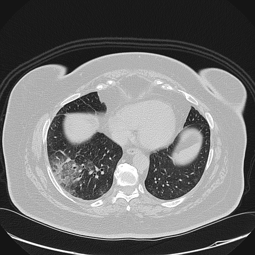 PNEUMONIA POR SARS-COV-2
