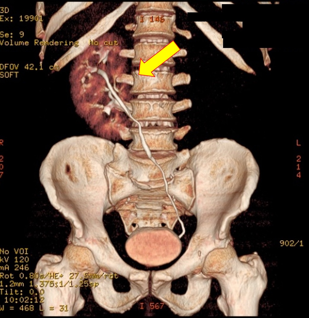 ABLAÇÃO POR RADIOFREQUÊNCIA DE CARCINOMA DE CÉLULAS RENAIS ASSOCIADO A ECTOPIA RENAL CRUZADA