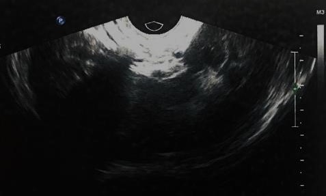 MALFORMAÇÃO MULLERIANA ASSOCIADA  A  ANOMALIA DE FUSÃO RENAL , HERNIAÇÃO OVARIANA NO CANAL DE NUCK E ENDOMETRIOSE:  ACHADOS INCIDENTAIS.