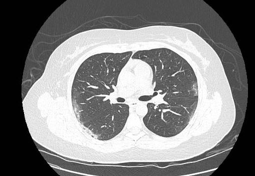 ACHADOS DE TOMOGRAFIA COMPUTADORIZADA NA INFECÇÃO PULMONAR VIRAL AGUDA PELO SARS-COV-2 
